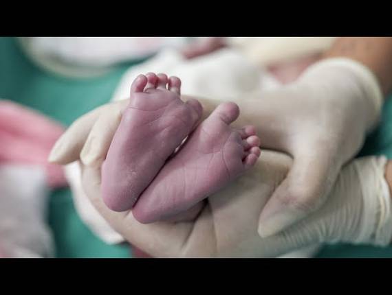 Parto Cesárea de Nascimento Perola