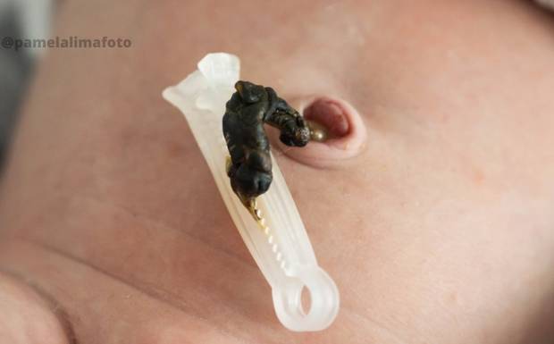 Como cuidar do Coto Umbilical do Recém-Nascido?