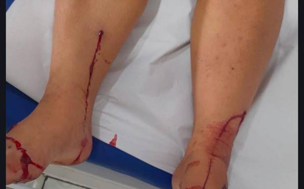 MULHER É FERIDA COM TIRO NOS PÉS APÓS NÃO AGUENTAR MAIS APANHAR DO MARIDO, NA ZONA RURAL DE HUMAITÁ