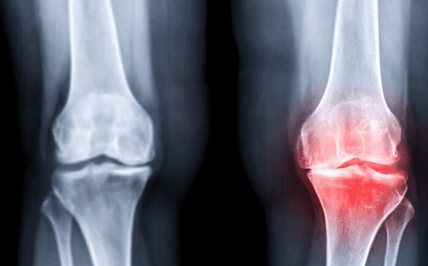 Osteoarthritis vs Rheumatoid Arthritis Explained: Understanding the Key Differences That Matter