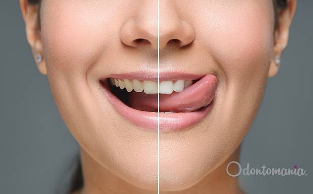 5 diferenças entre os trabalhos estéticos na odontologia, confeccionados com Resina e Porcelana