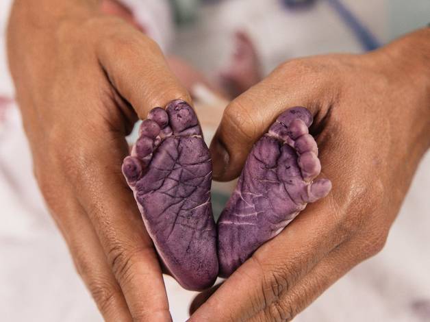 Parto de Nascimento - Anthony