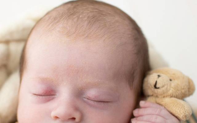 O que é a crosta lactéa?