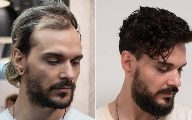 Valuable tips for choosing the right hair systems for men