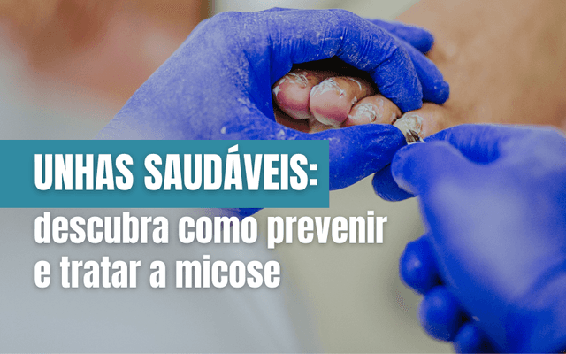 Unhas saudáveis: descubra como prevenir e tratar a micose