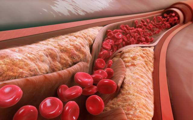 How to control blood sugar level in type 2 diabetes