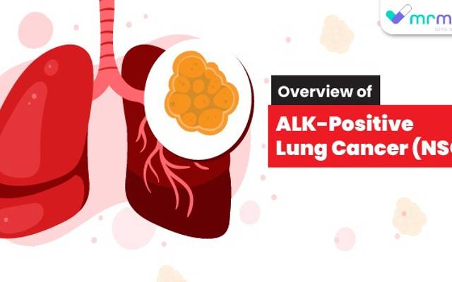 Overview of ALK-Positive Lung Cancer (NSCLC)