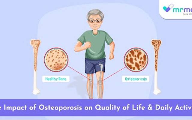 The Impact of Osteoporosis on Quality of Life and Daily Activities