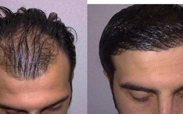 Thinking about a Dubai Hair Transplant? Discover a detailed personal journey through consultation, procedure, recovery, and r