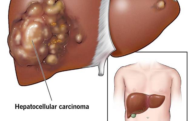 Hepato Burn: Liver Defense and Detox Program for Lasting Vitality
