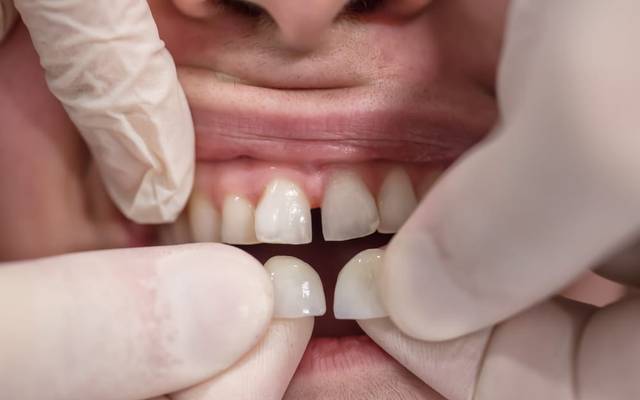 Enhance Your Smile with Custom Dental Veneers | Trusted Dentist in Diamond Bar