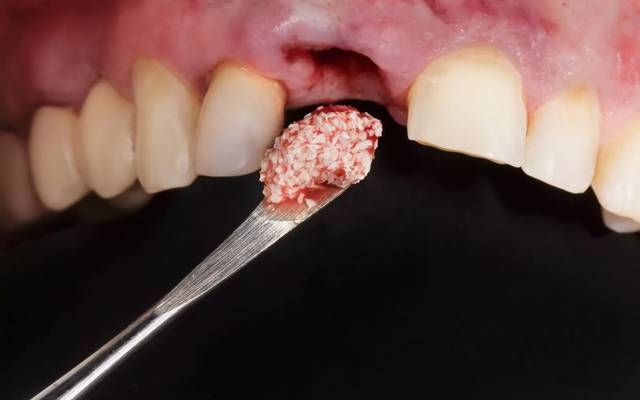 Your Guide to Dental Fillings Near Me: Expert Care From a Trusted Dentist in Diamond Bar