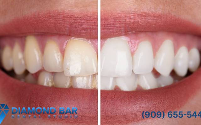 Transform Your Smile with Dental Veneers at a Leading Diamond Bar Dental Center