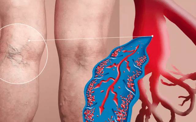 VeinCare Varicose Vein Root Remove Australia Reviews (A Honest Customer Feedback) Ingredients And Benefits Analysis!!