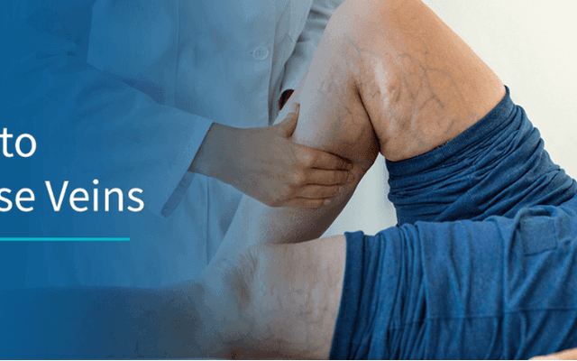 VeinCare Varicose Vein Root Remove Australia (Official™) - Is It Worth the Hype?