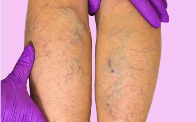 VeinCare Varicose Vein Root Remove Australia SCAM ALERT? Read My Experience!