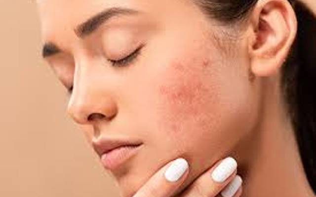 Niacinamide vs. Acne | The Ultimate Showdown for Clear Skin