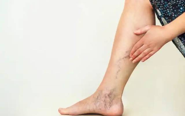 Venovixil Vein Care Cream Canada :- Improve Your Vein Appearance with Venovixil Canada !!

