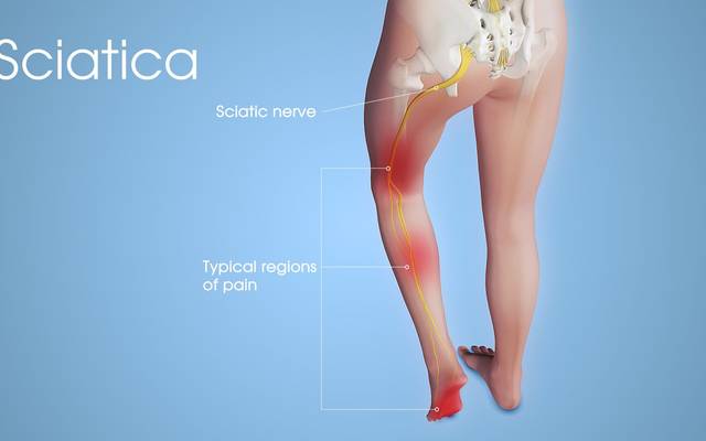 Sciaticyl Sciatic Pain Reviews - Does it Really Work? The Truth!