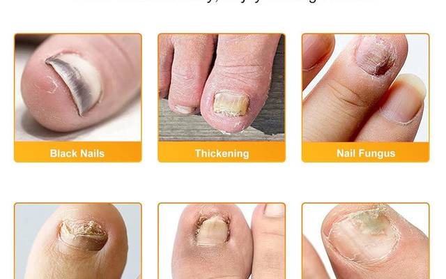 Fungabeam Cream Benefits: How It Helps Eliminate Stubborn Fungal Infections
What Is Fungabeam? Complete Guide to Ingredients