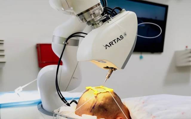 How Accurate Is Robotic Hair Transplant Technology?