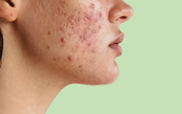 Are Acne Treatments Safe for Sensitive Skin?