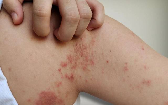 Are Skin Disease Treatments Safe for Sensitive Skin?