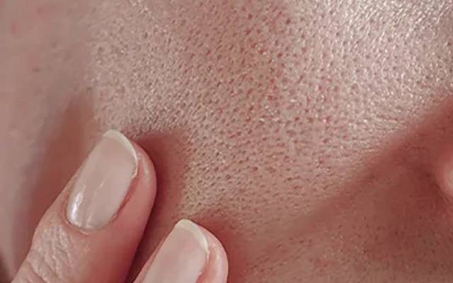 Are Enlarged Pores Linked to Aging or Excess Sebum Production?
