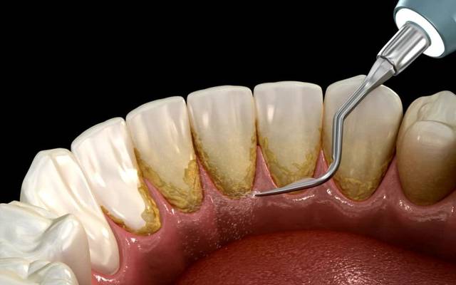 Can Teeth Scaling Completely Remove Plaque and Tartar?