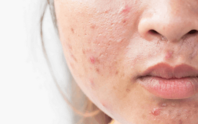 Is Microdermabrasion Effective for Acne?