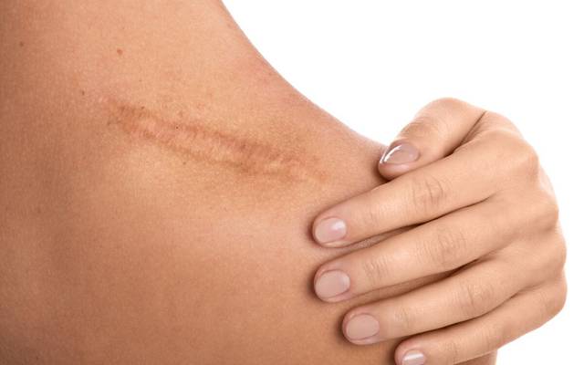 What Scar Removal Involves Clinically?