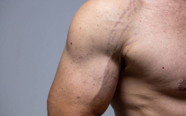What Stretch Marks Removal Addresses?