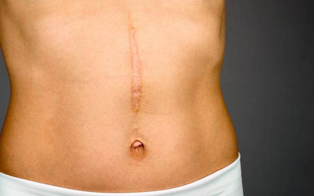 Does Keloid Treatment Improve Overall Skin Clarity?