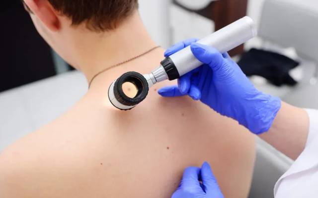 Is Moles Removal a Reliable Method for Skin Refinement?
