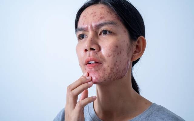 Is Acne Treatment Effective Across Various Age Groups?