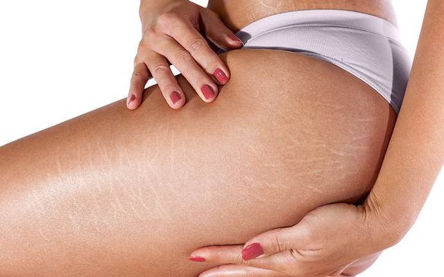Is Stretch Marks Laser Removal Price Consistent Everywhere