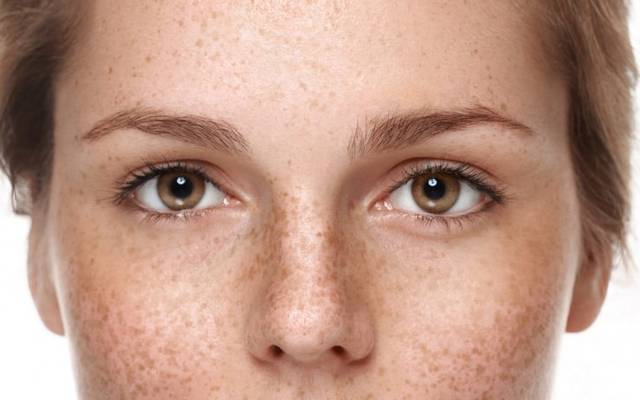 What Makes Pigmentation Removal a Common Skin Concern?