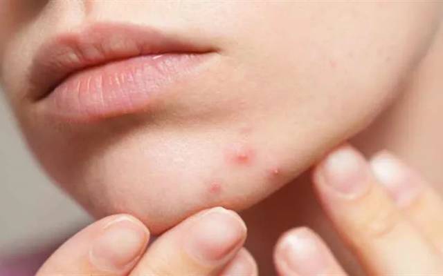 How Can Pimples Treatment Enhance Overall Skin Appearance?
