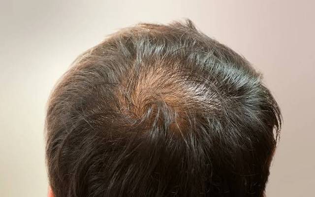 Does Crown Hair Transplants Create Natural Hair Patterns?