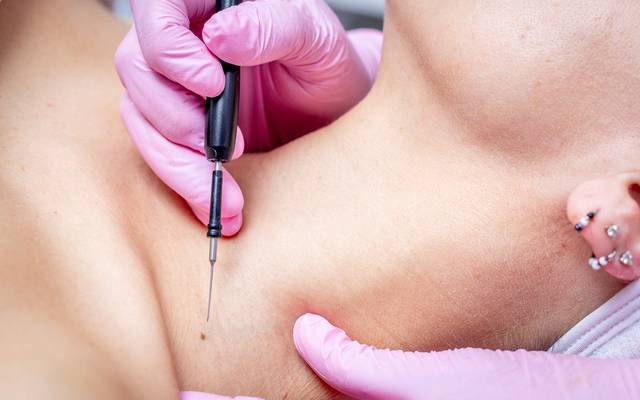 Does Mole removal Address Benign Skin Growths?