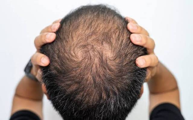 How Does Donor Supply Affect Crown Hair Transplants?