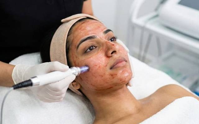 What Aftercare Considerations Follow a Vampire Facial?