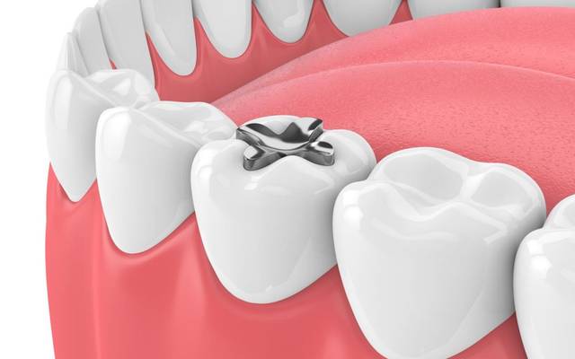 Dental Tooth Filling for Sensitive Teeth: What to Expect