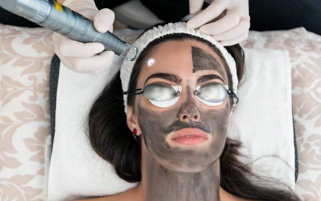 Is Laser Carbon Peel Good for Acne-Prone Skin?
