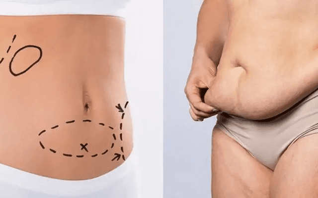 How to Prepare for Laser Liposuction Surgery


