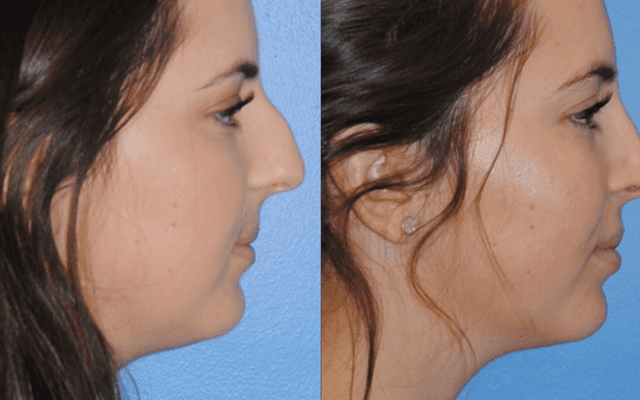 Non-Surgical Rhinoplasty: Realistic Expectations