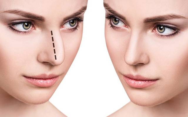Non-Surgical Rhinoplasty for Minor Nose Reshaping