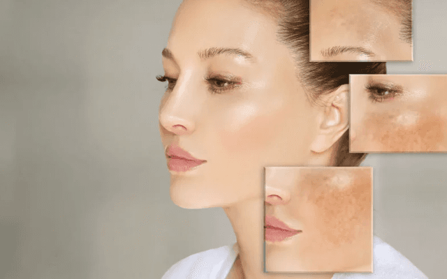 How to Track Progress During Melasma Treatment