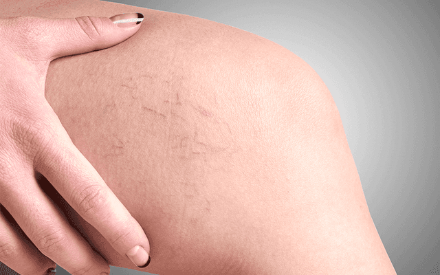 Spider Veins Treatment: A Simple Explanation