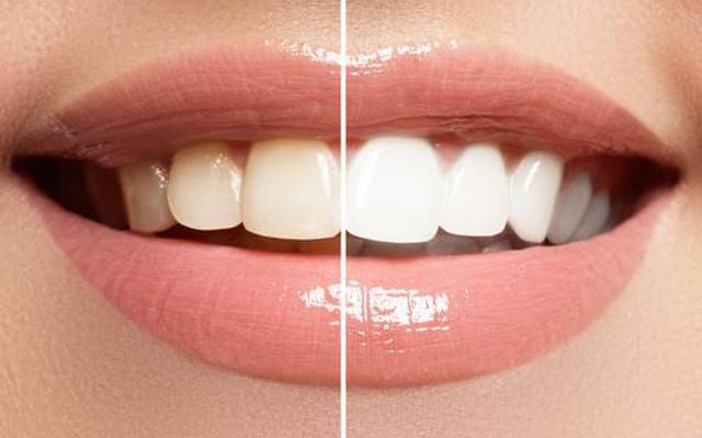 How to Whiten Teeth Naturally Without Harsh Chemicals